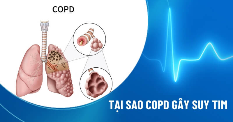 copd kèm suy tim