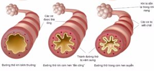 copd kèm tăng huyết áp