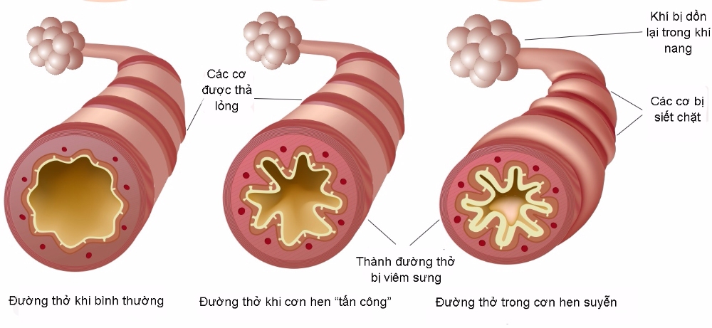 copd kèm tăng huyết áp