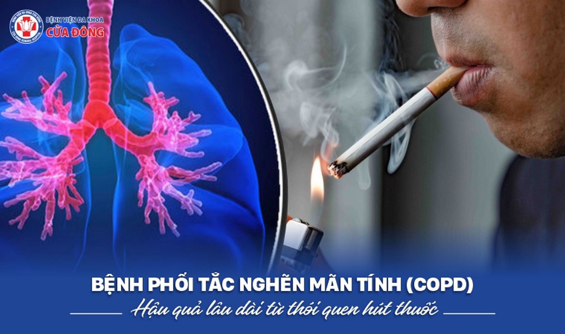 copd ở người hút thuốc lâu năm - Image 1