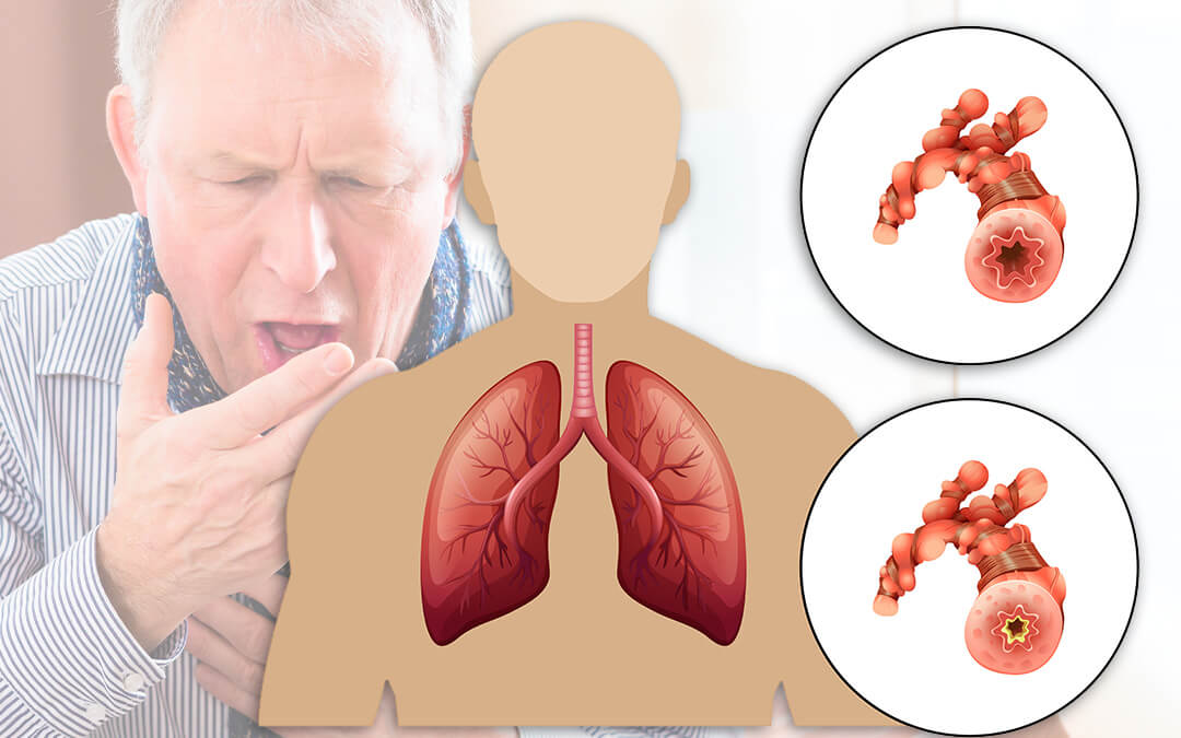 copd tái phát đợt cấp - Image 3