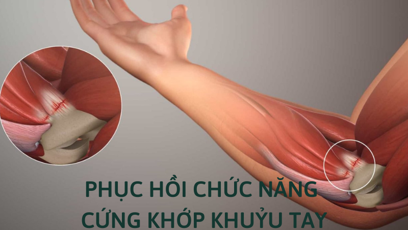 cứng khớp khuỷu tay sau bó bột