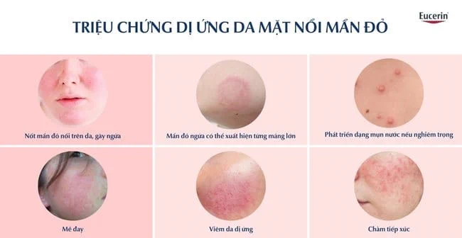 da mặt dễ dị ứng - Image 4