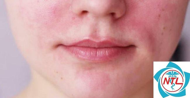 da mặt dễ dị ứng