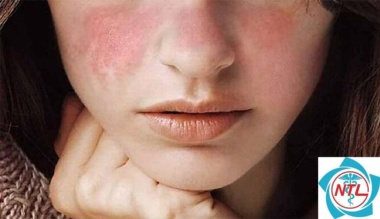 da mặt đỏ và bong tróc - Image 2