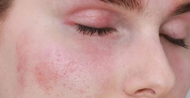 da mặt nhạy cảm