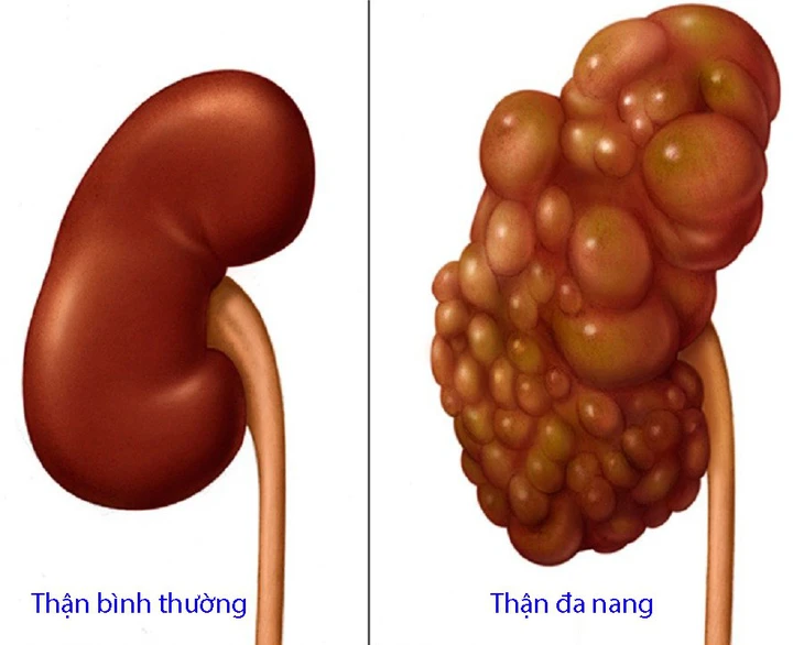 đa nang thận - Image 4