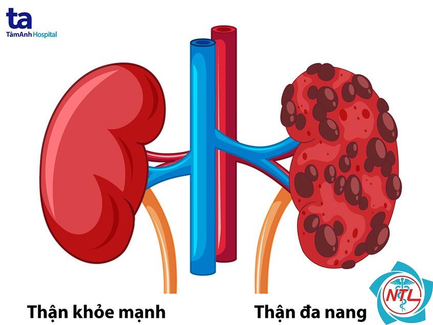 đa nang thận