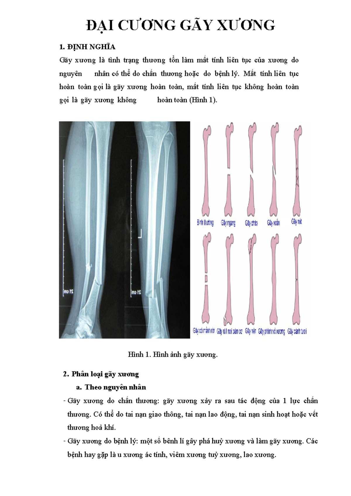 đại cương gãy xương - Image 2