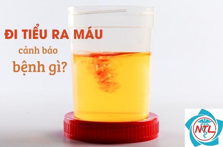 đái ra máu là bệnh gì - Image 5