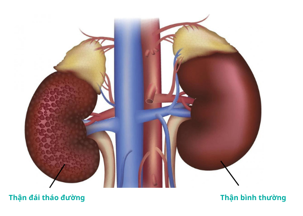 đái tháo đường kèm bệnh thận - Image 5