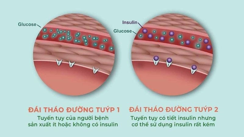 đái tháo đường type 2 ở người lớn - Image 5