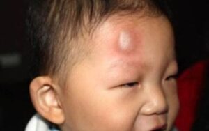đập đầu vào tường bị sưng