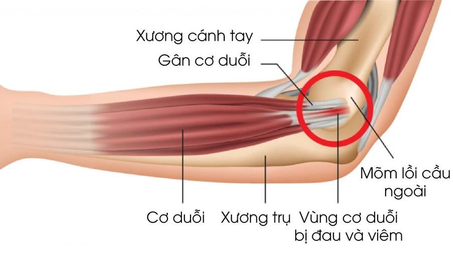 đau cơ duỗi cánh tay - Image 4