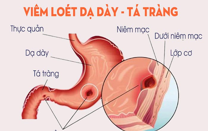 đau dạ dày kèm buồn nôn - Image 5