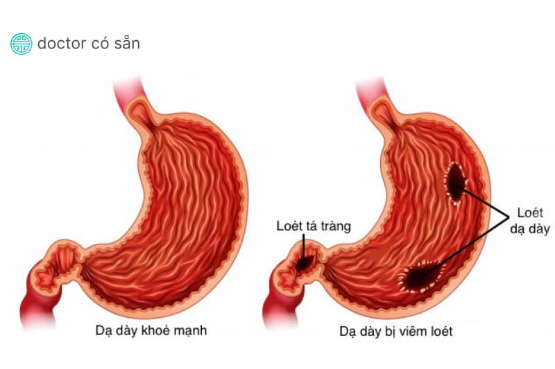 đau dạ dày kèm đi ngoài phân đen - Image 3