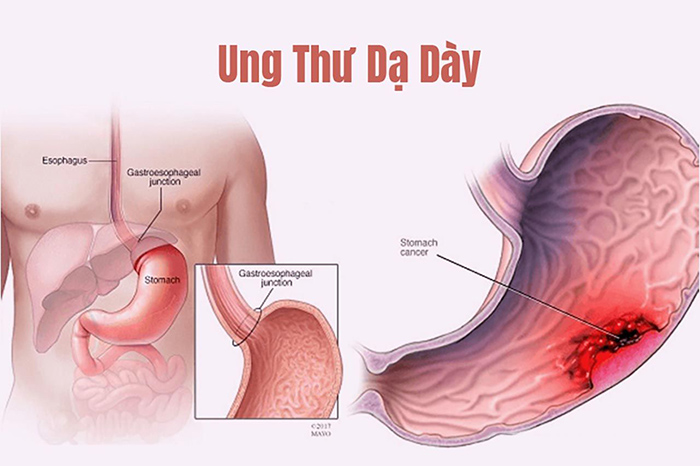 đau dạ dày kèm sụt cân - Image 2