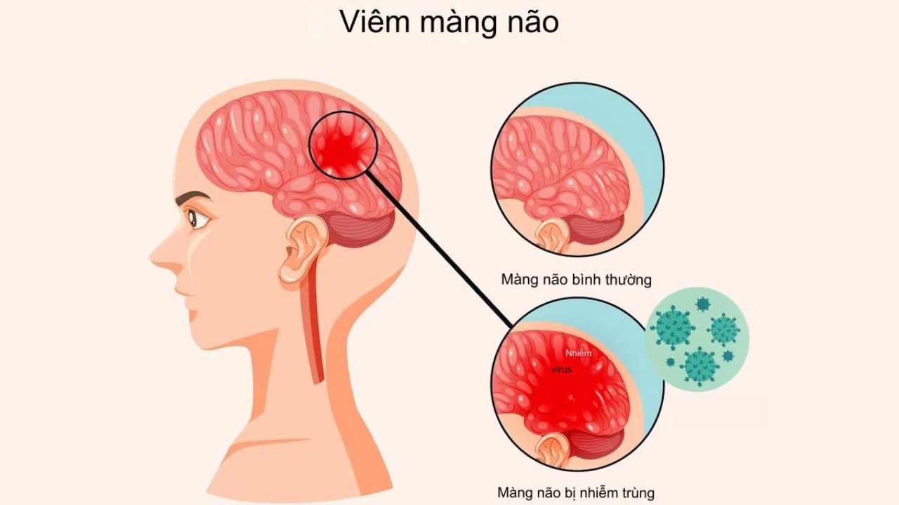 đau đầu kéo dài - Image 4