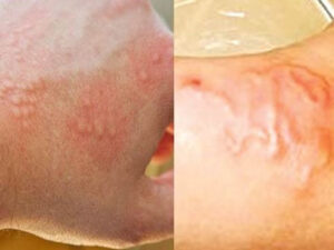 dấu hiệu bị giun trong bụng