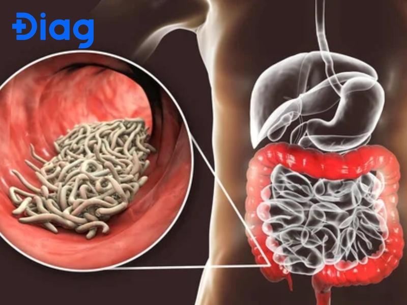 dấu hiệu có lãi trong bụng - Image 4