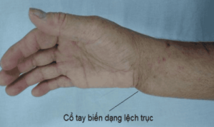 dấu hiệu của gãy xương
