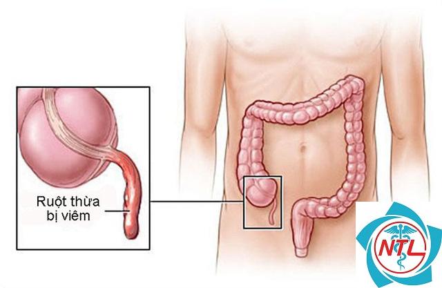 dấu hiệu đau ruột thừa ở trẻ nhỏ - Image 3