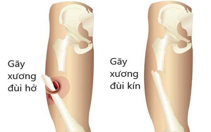 dấu hiệu gãy xương - Image 5