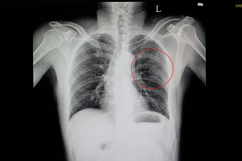 dấu hiệu rạn xương - Image 4