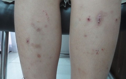 dấu hiệu trẻ bị giun - Image 2