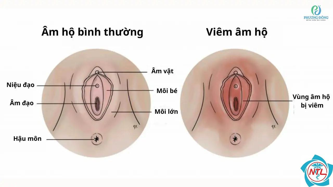 dấu hiệu viêm âm đạo - Image 2