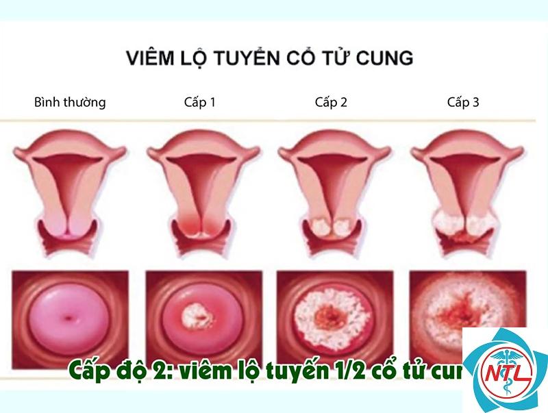 dấu hiệu viêm âm đạo - Image 3