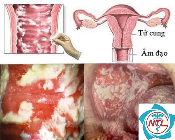 dấu hiệu viêm âm đạo - Image 4