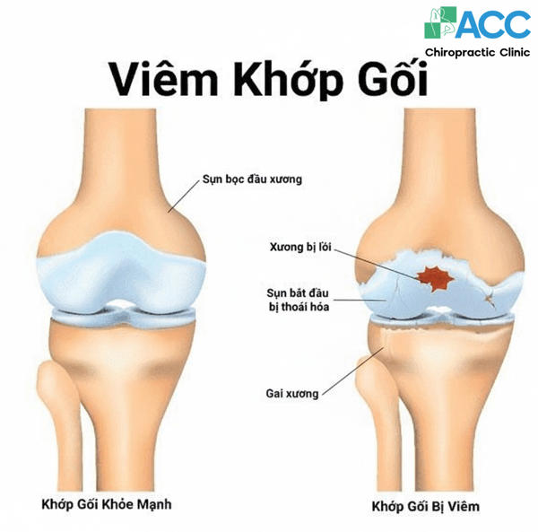 đau khớp gối - Image 4