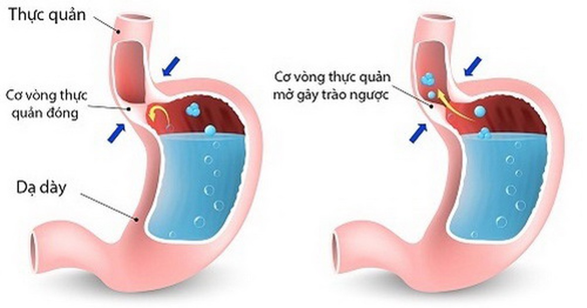 đau ngực do trào ngược dạ dày - Image 2