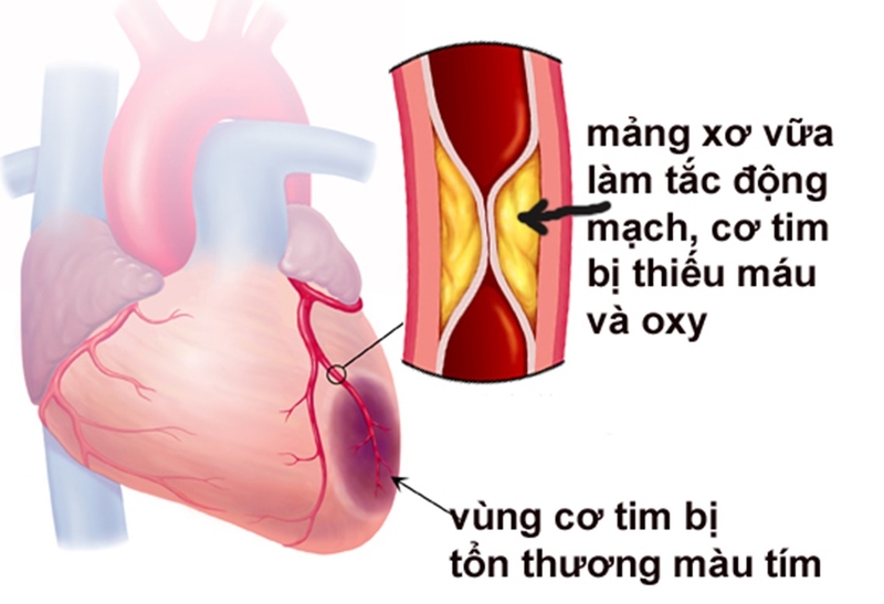 đau ngực kèm buồn nôn - Image 4