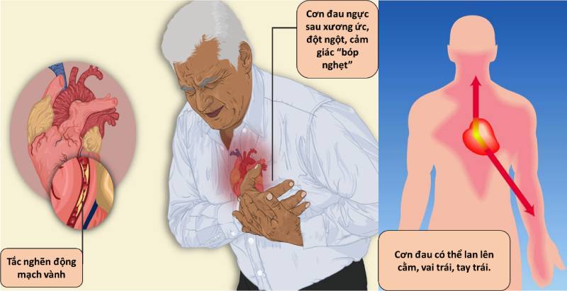 đau ngực ở người có bệnh tim - Image 3