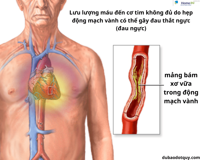 đau thắt ngực - Image 5
