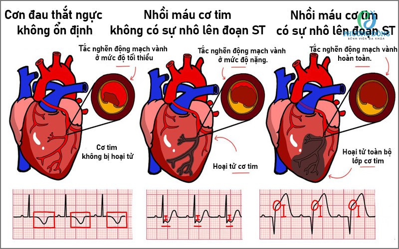 đau thắt ngực không ổn định - Image 2