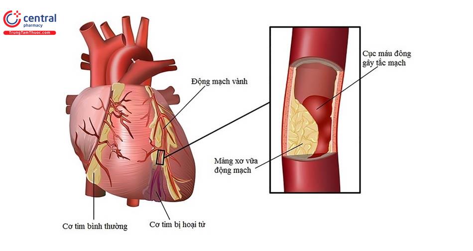 đau thắt ngực không ổn định - Image 3
