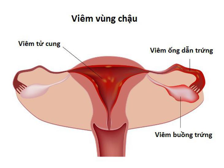 đau vùng chậu - Image 3
