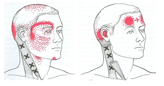 đau xương sau tai phải - Image 3