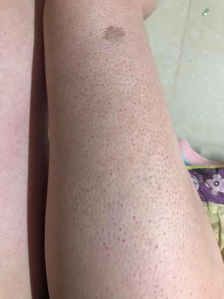 dày sừng nang lông