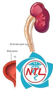 dị tật niệu quản