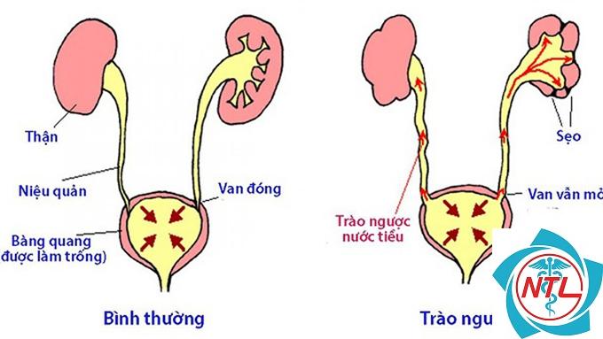 dị tật niệu quản - Image 2