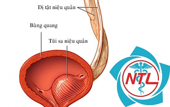 dị tật niệu quản - Image 3