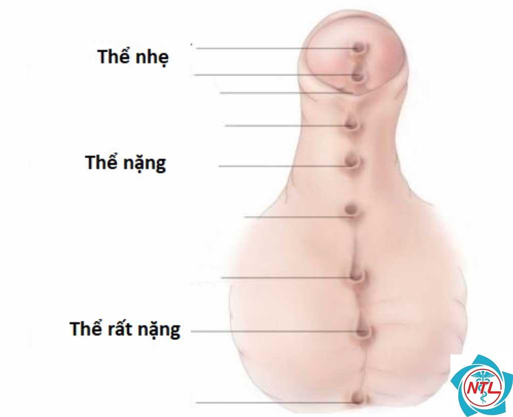 dị tật niệu quản - Image 5