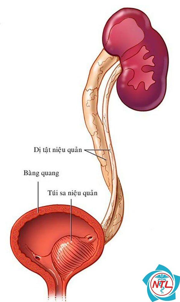 dị tật niệu quản