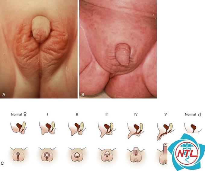 dị tật thận bẩm sinh - Image 2