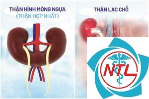 dị tật thận bẩm sinh