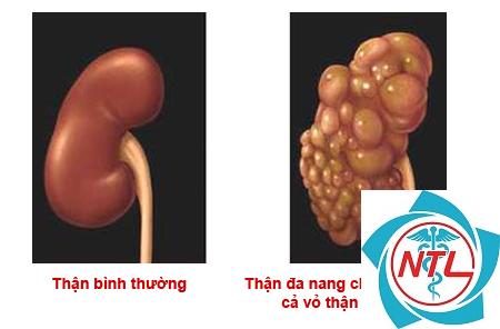 dị tật thận bẩm sinh - Image 5